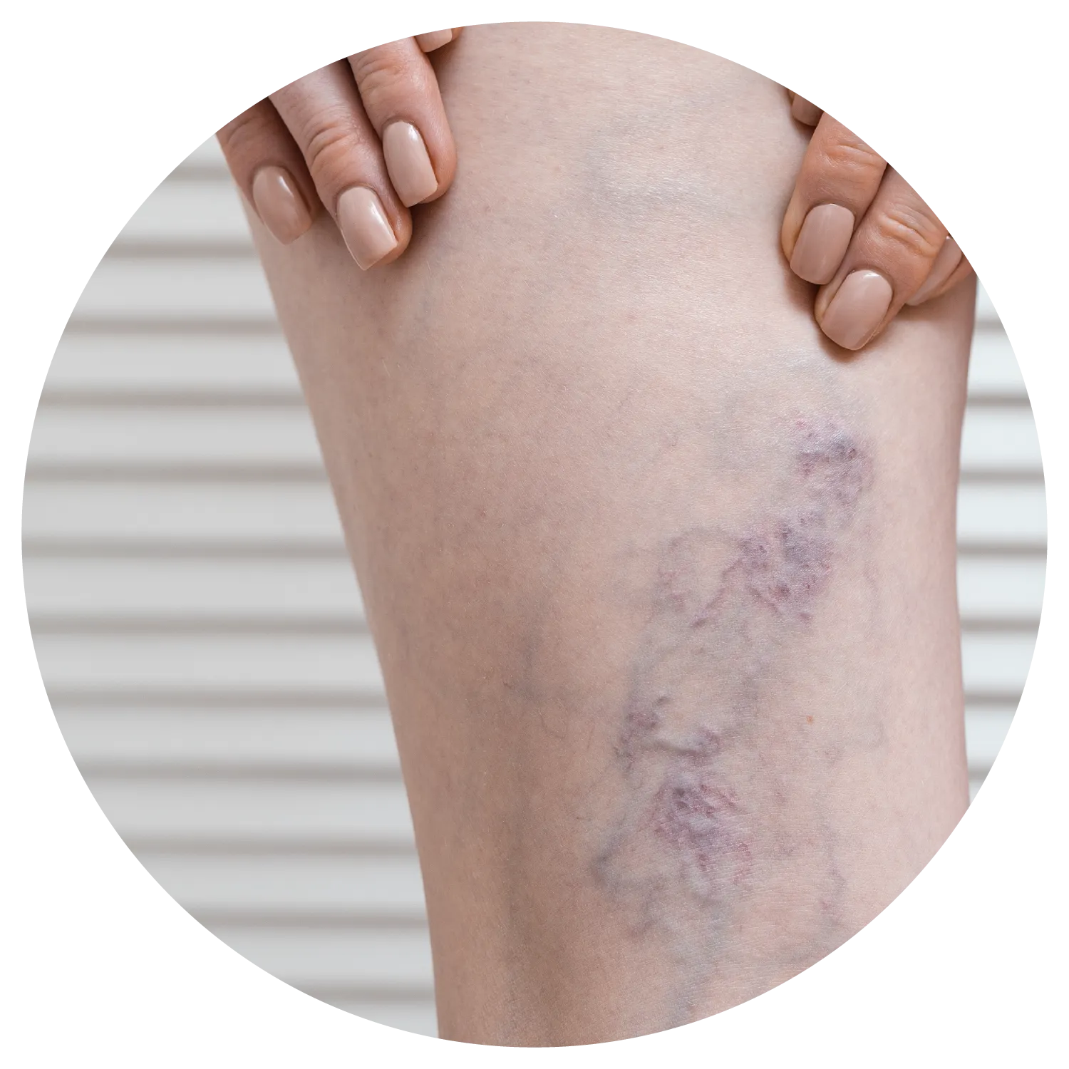 Spider Veins treatment results at Toronto medical spa - The Chain Reaction of Symptoms